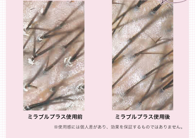 ミラブルプラス使用前 ミラブルプラス使用後 ※使用感には個人差があり、効果を保証するものではありません。
